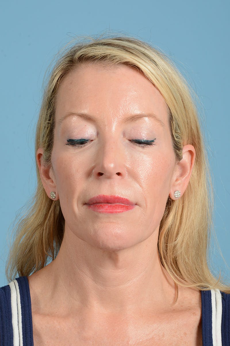 Facelift Before & After Gallery - Patient 694453 - Image 7