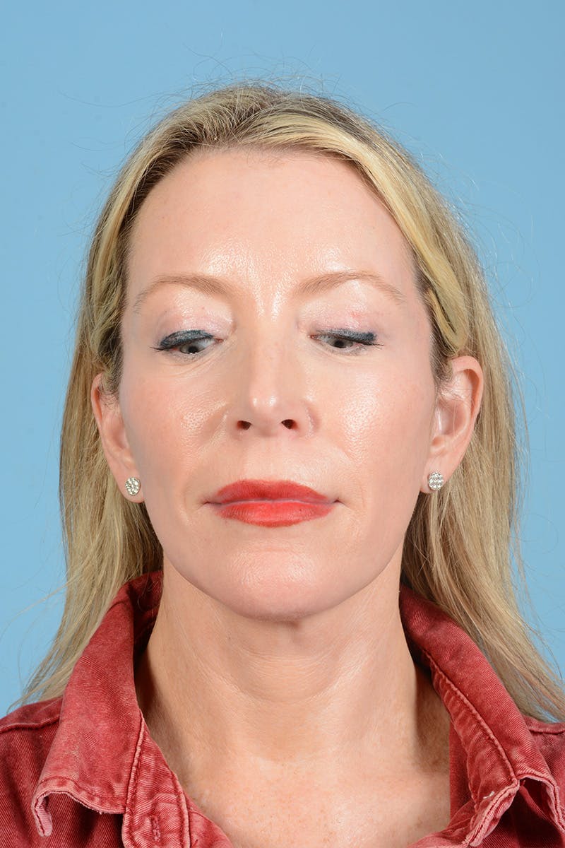 Facelift Before & After Gallery - Patient 694453 - Image 8