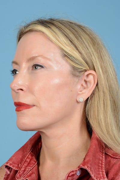 Facelift Before & After Gallery - Patient 694453 - Image 14