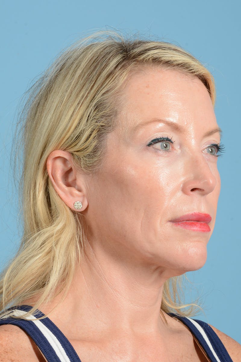 Facelift Before & After Gallery - Patient 694453 - Image 9