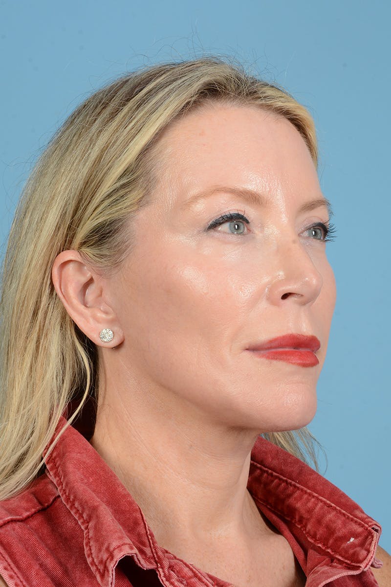 Facelift Before & After Gallery - Patient 694453 - Image 10