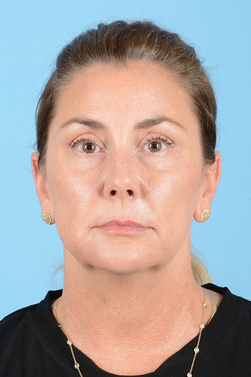 Facial Augmentation Before & After Gallery - Patient 193015 - Image 1