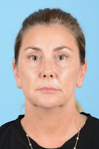 Facial Augmentation Before & After Gallery - Patient 193015 - Image 1