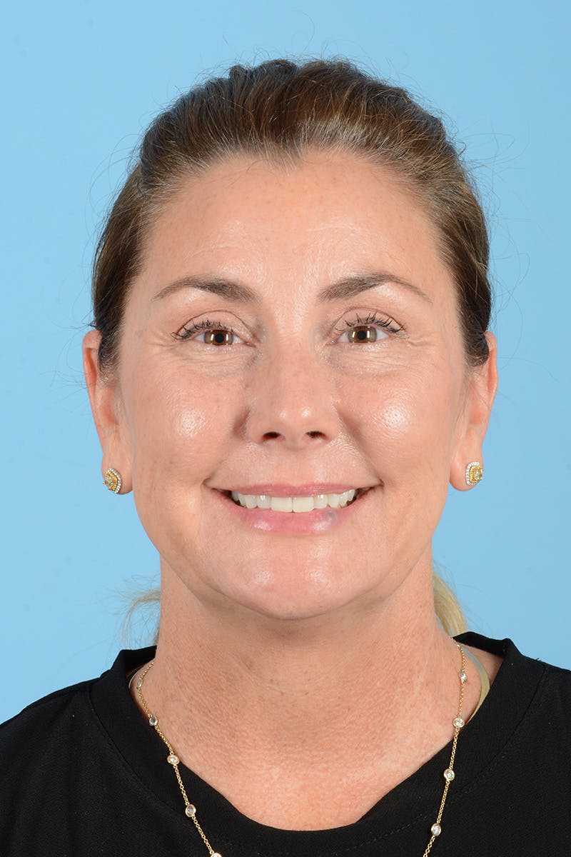 Facial Augmentation Before & After Gallery - Patient 193015 - Image 3