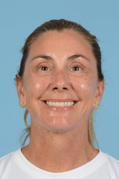 Facial Augmentation Before & After Gallery - Patient 193015 - Image 4