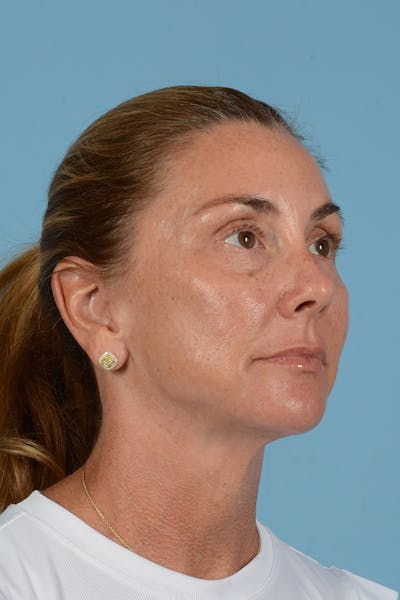 Facial Augmentation Before & After Gallery - Patient 193015 - Image 6