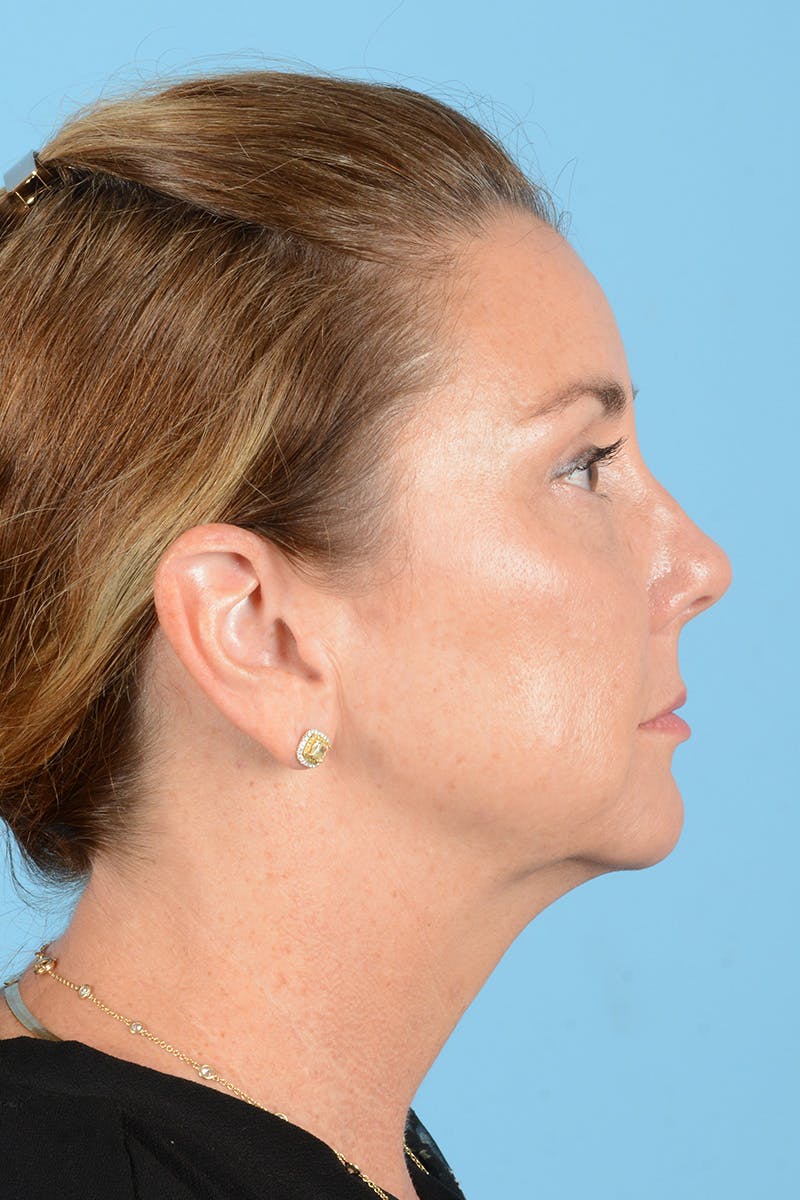 Facial Augmentation Before & After Gallery - Patient 193015 - Image 7