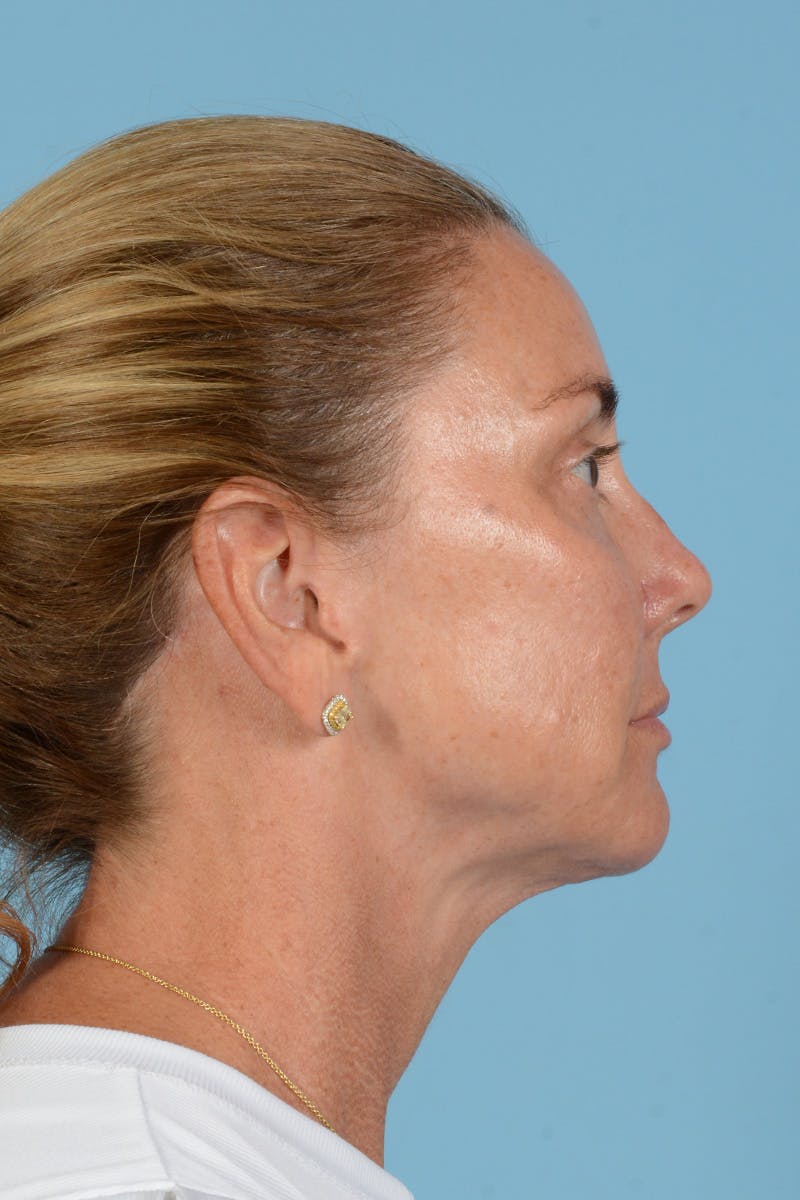 Facial Augmentation Before & After Gallery - Patient 193015 - Image 8