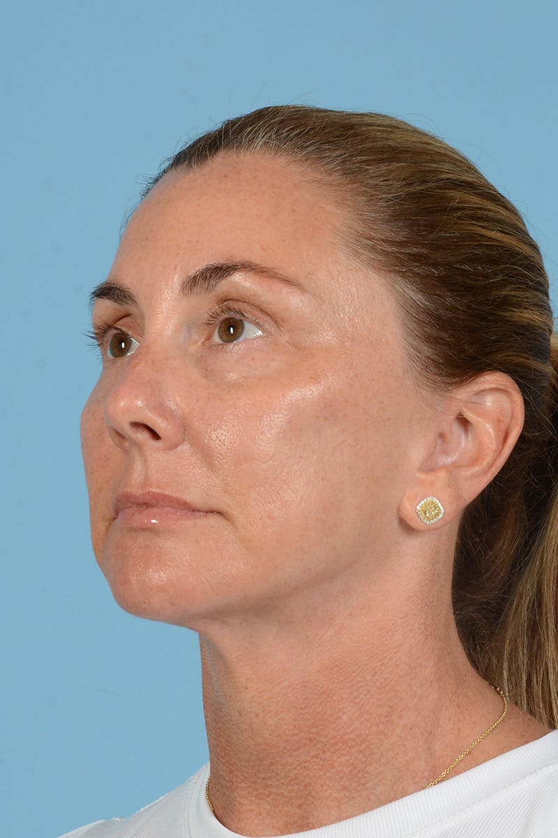 Facial Augmentation Before & After Gallery - Patient 193015 - Image 10