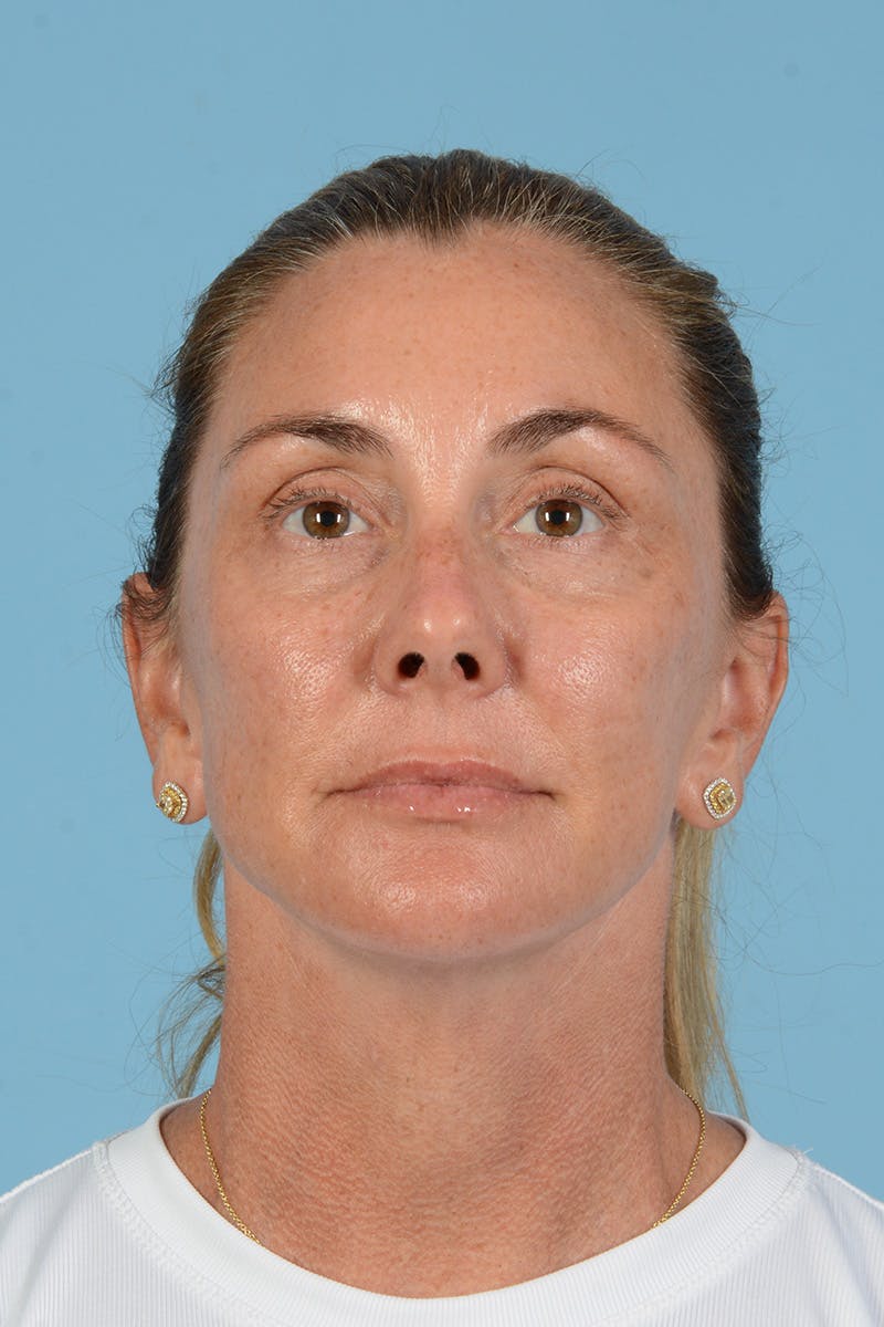 Facial Augmentation Before & After Gallery - Patient 193015 - Image 2