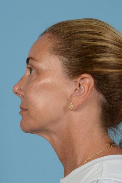 Facial Augmentation Before & After Gallery - Patient 193015 - Image 12
