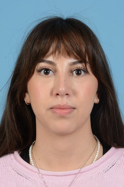 Rhinoplasty Before & After Gallery - Patient 249949 - Image 2