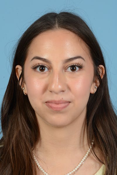 Rhinoplasty Before & After Gallery - Patient 249949 - Image 1