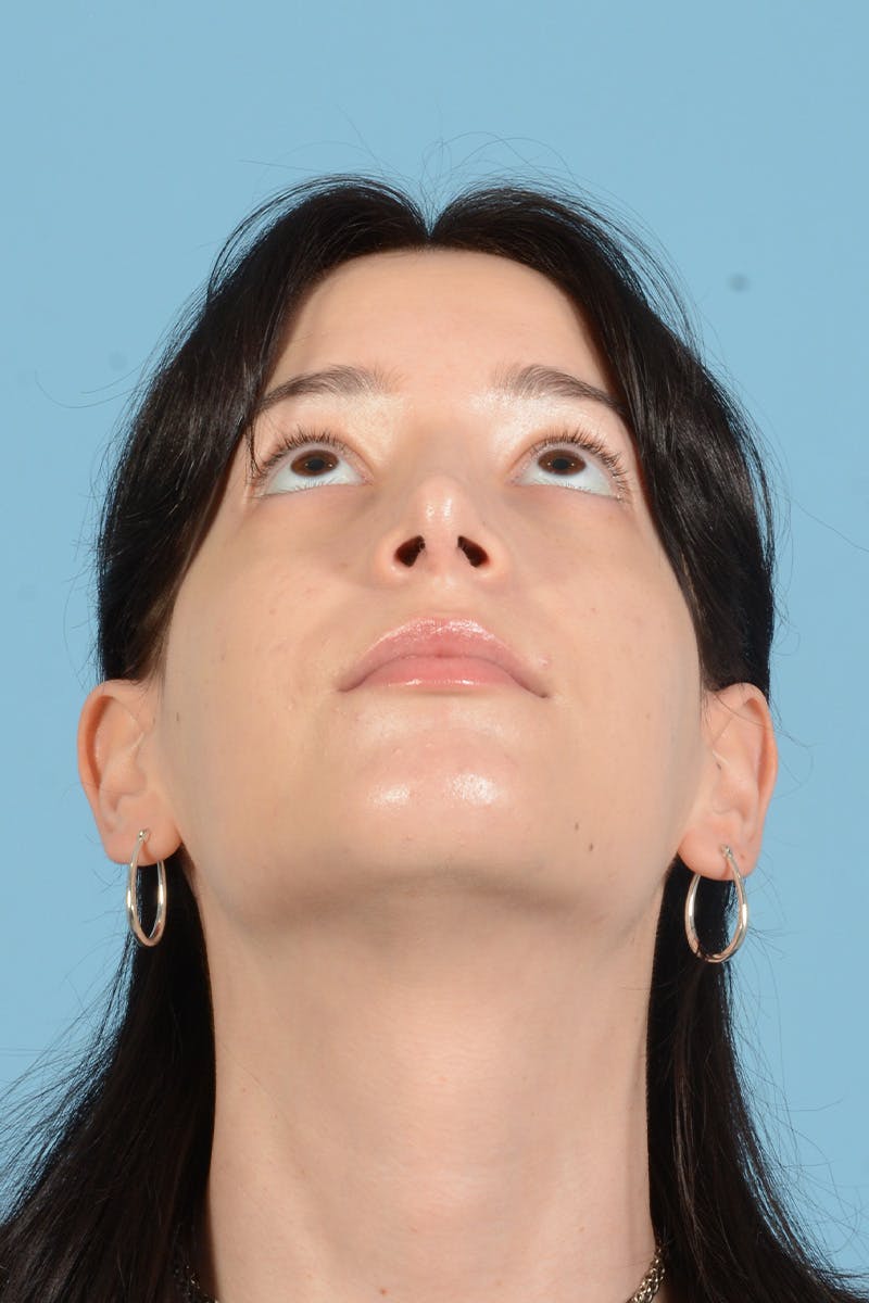 Facial Augmentation Before & After Gallery - Patient 281591 - Image 6