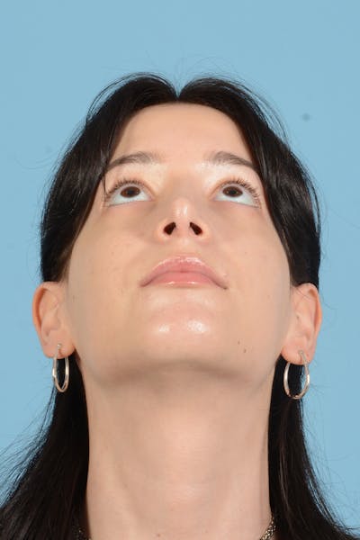 Facial Augmentation Before & After Gallery - Patient 281591 - Image 6