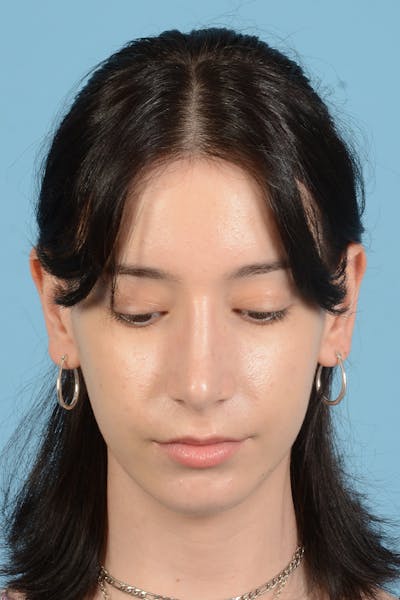 Facial Augmentation Before & After Gallery - Patient 281591 - Image 4