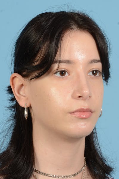 Facial Augmentation Before & After Gallery - Patient 281591 - Image 8