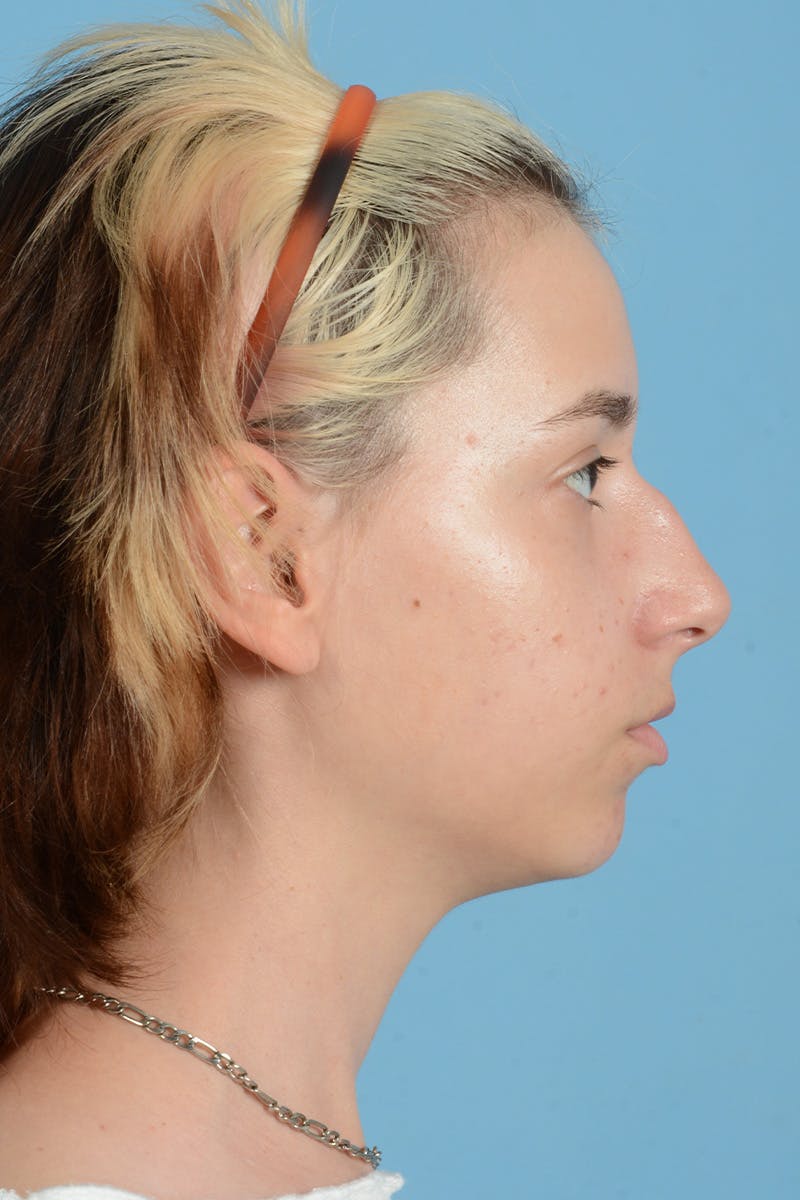 Facial Augmentation Before & After Gallery - Patient 281591 - Image 9