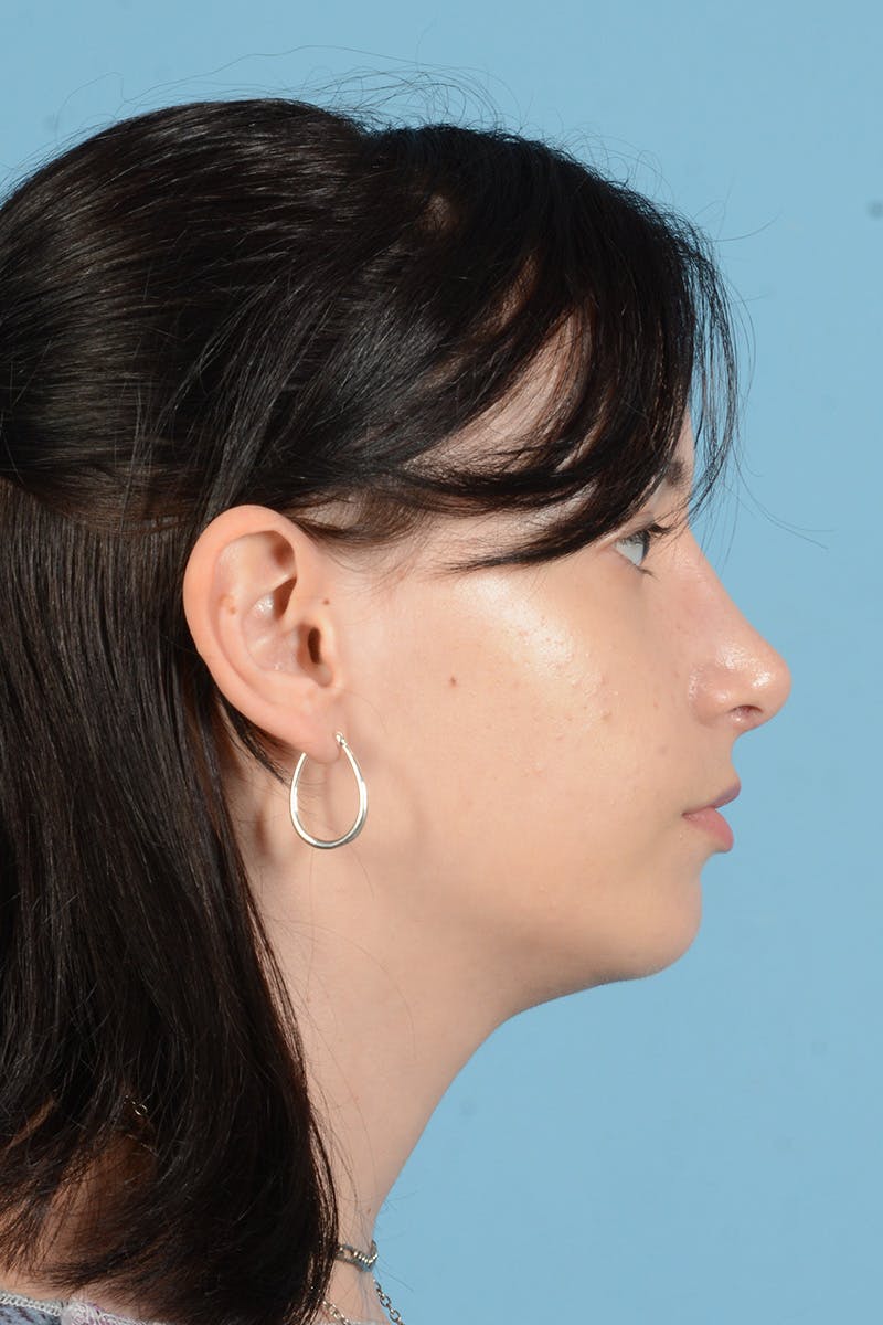 Facial Augmentation Before & After Gallery - Patient 281591 - Image 10