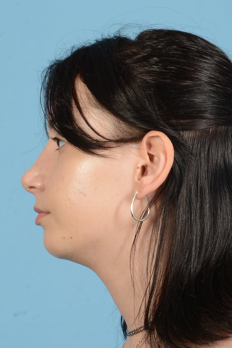 Facial Augmentation Before & After Gallery - Patient 281591 - Image 14