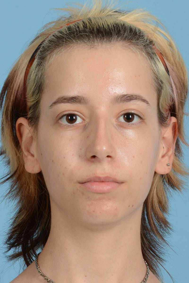 Facial Augmentation Before & After Gallery - Patient 281591 - Image 1