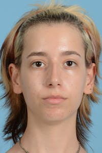 Facial Augmentation Before & After Gallery - Patient 281591 - Image 1