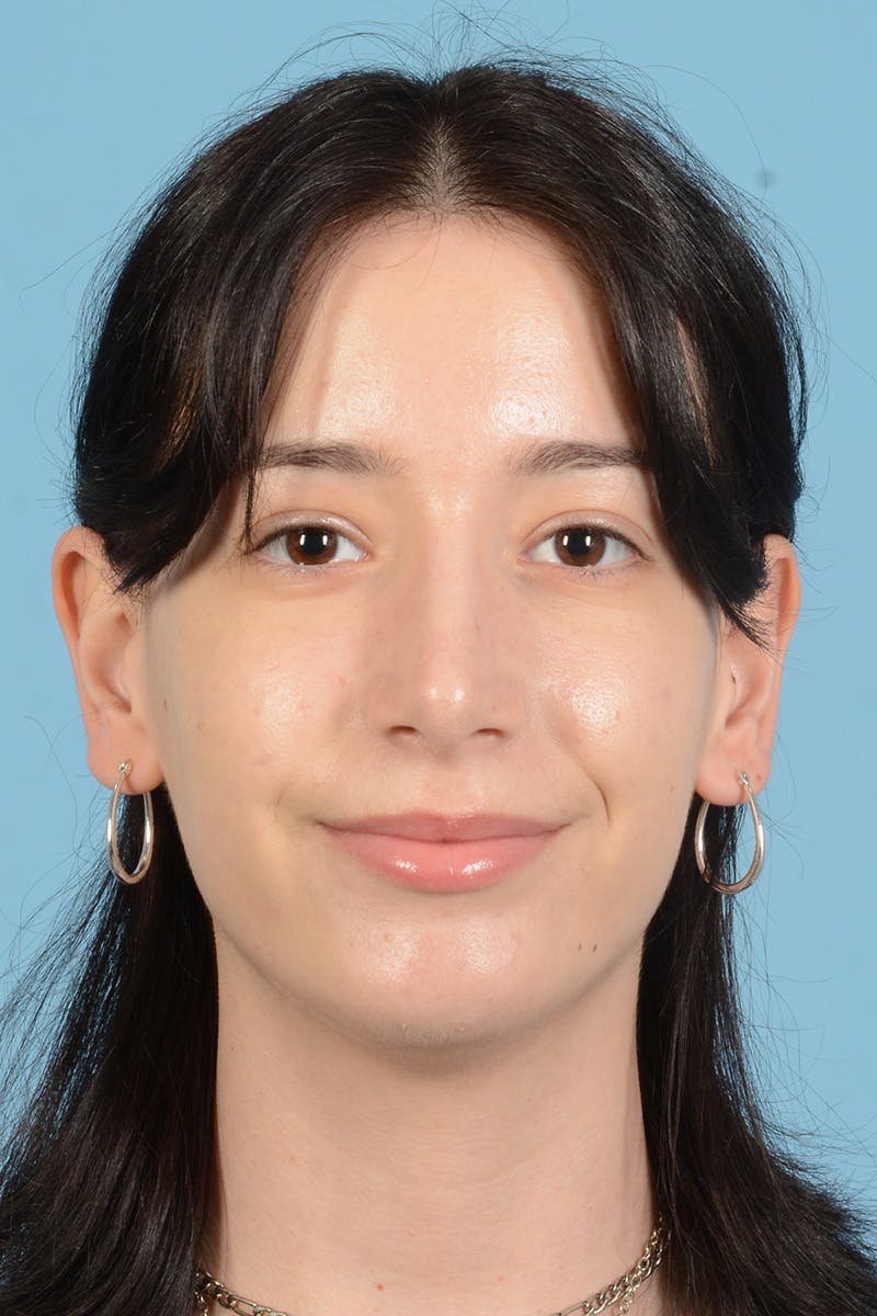 Facial Augmentation Before & After Gallery - Patient 281591 - Image 2