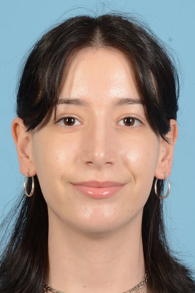 Facial Augmentation Before & After Gallery - Patient 281591 - Image 2