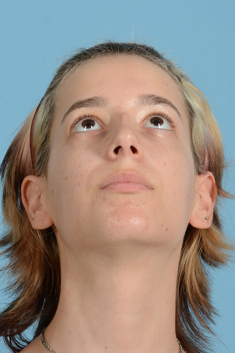 Facial Augmentation Before & After Gallery - Patient 281591 - Image 5