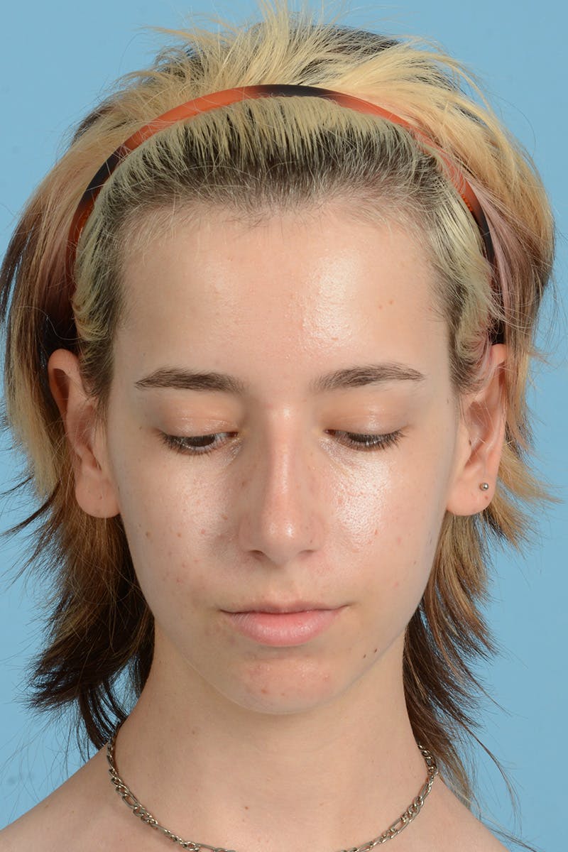 Facial Augmentation Before & After Gallery - Patient 281591 - Image 3