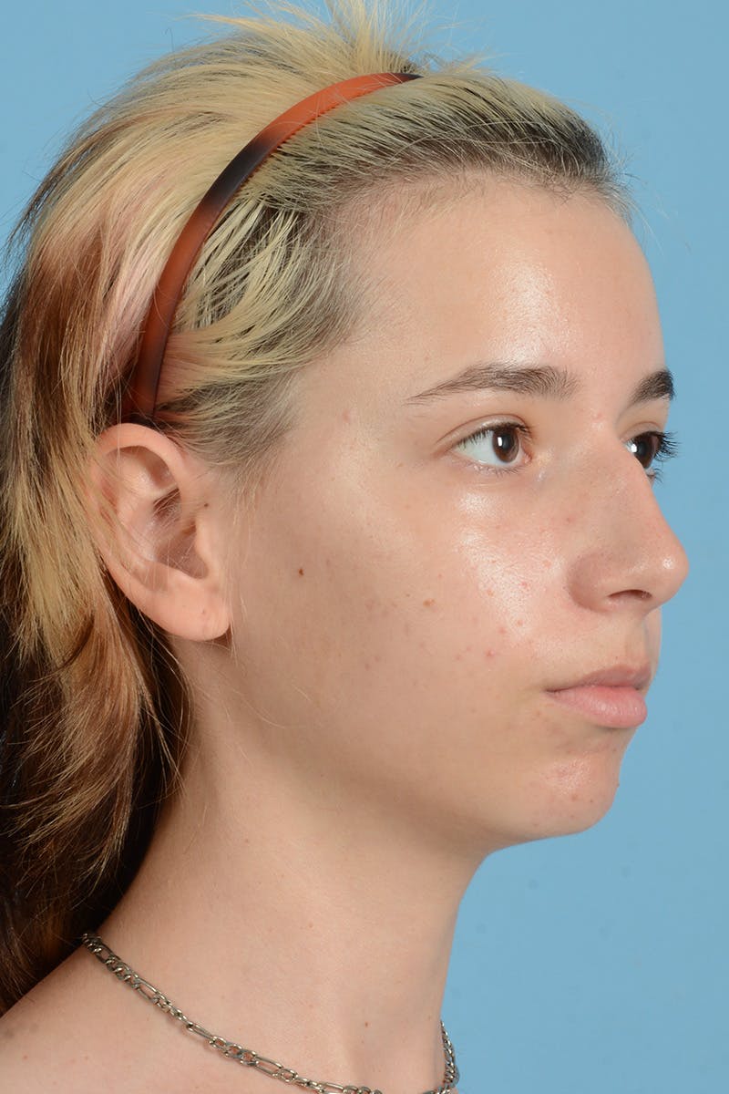 Facial Augmentation Before & After Gallery - Patient 281591 - Image 7