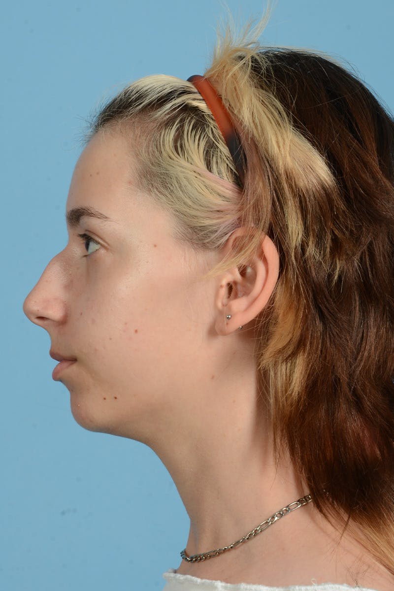 Facial Augmentation Before & After Gallery - Patient 281591 - Image 13