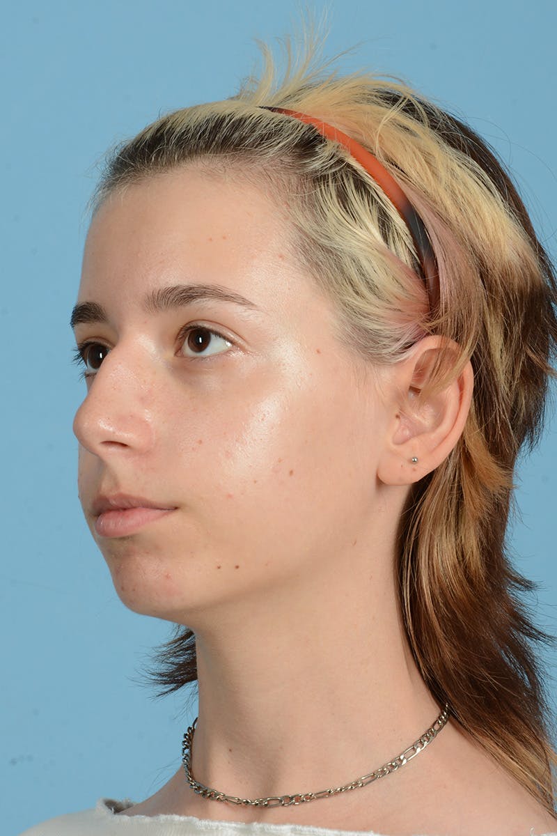 Facial Augmentation Before & After Gallery - Patient 281591 - Image 11