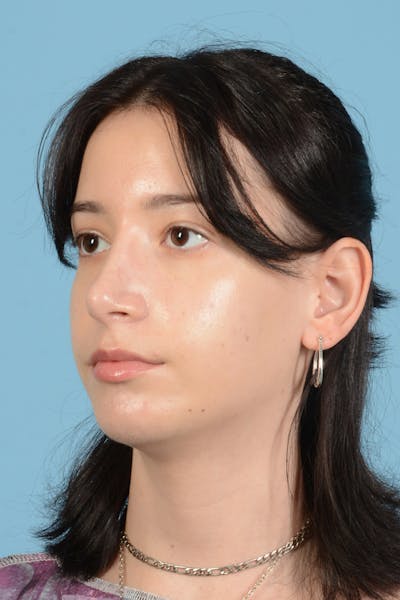 Facial Augmentation Before & After Gallery - Patient 281591 - Image 12