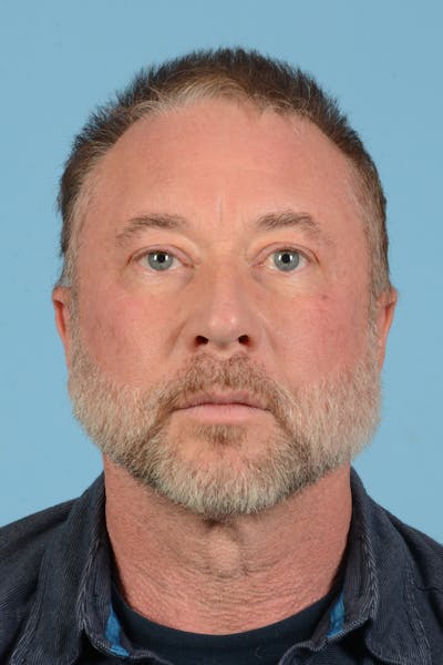 Rhinoplasty Before & After Gallery - Patient 366148 - Image 1