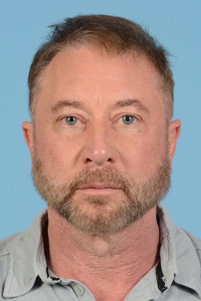 Rhinoplasty Before & After Gallery - Patient 366148 - Image 2