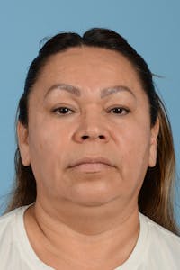 Endoscopic Brow Lift Before & After Gallery - Patient 314786 - Image 1