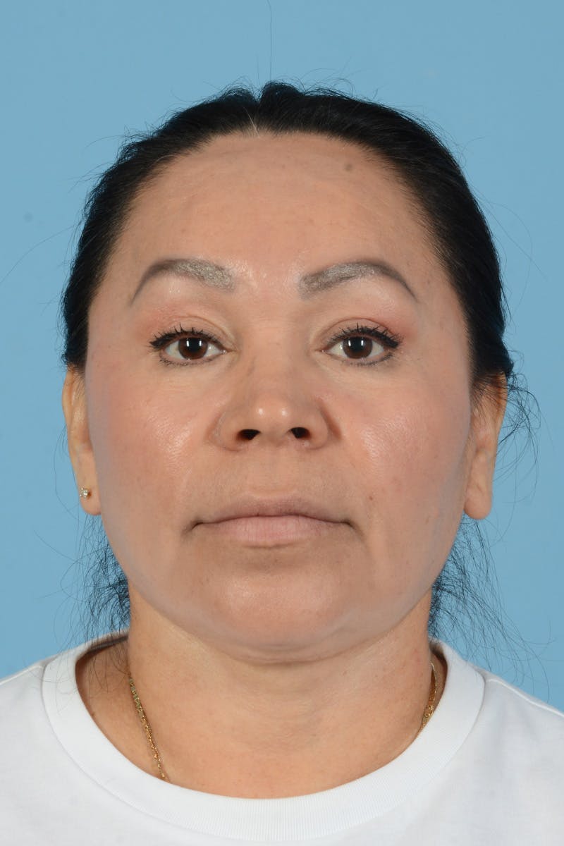 Endoscopic Brow Lift Before & After Gallery - Patient 314786 - Image 2