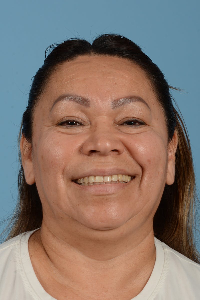 Endoscopic Brow Lift Before & After Gallery - Patient 314786 - Image 3