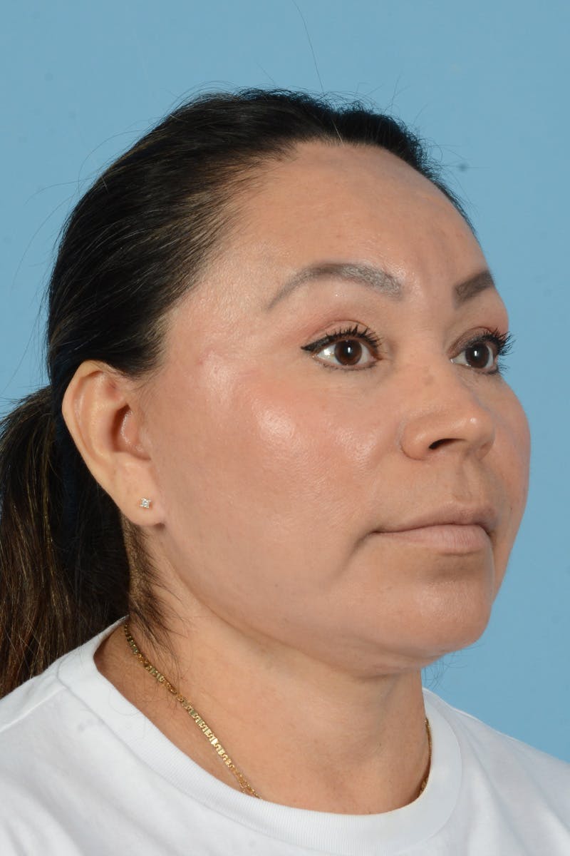 Endoscopic Brow Lift Before & After Gallery - Patient 314786 - Image 6