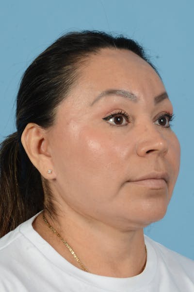 Endoscopic Brow Lift Before & After Gallery - Patient 314786 - Image 6