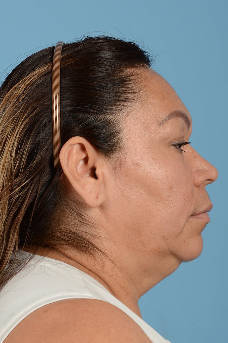 Endoscopic Brow Lift Before & After Gallery - Patient 314786 - Image 7