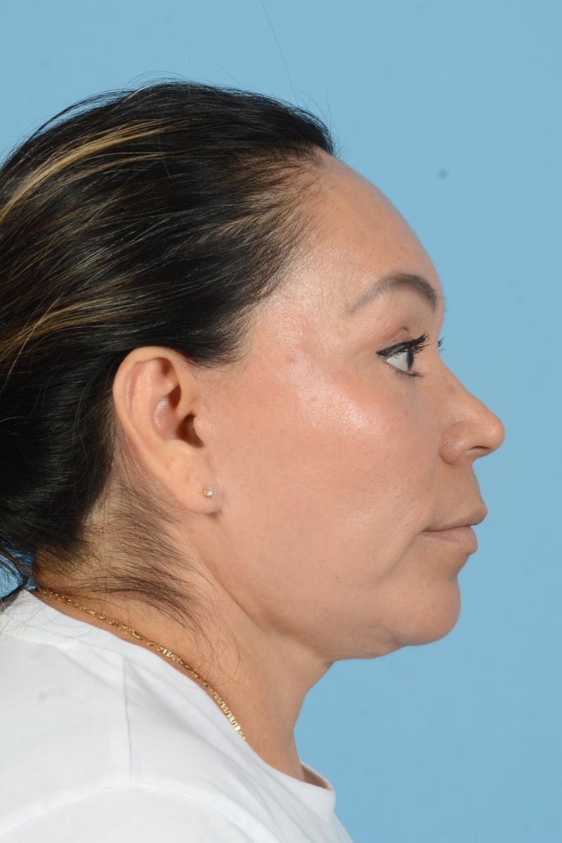 Endoscopic Brow Lift Before & After Gallery - Patient 314786 - Image 8