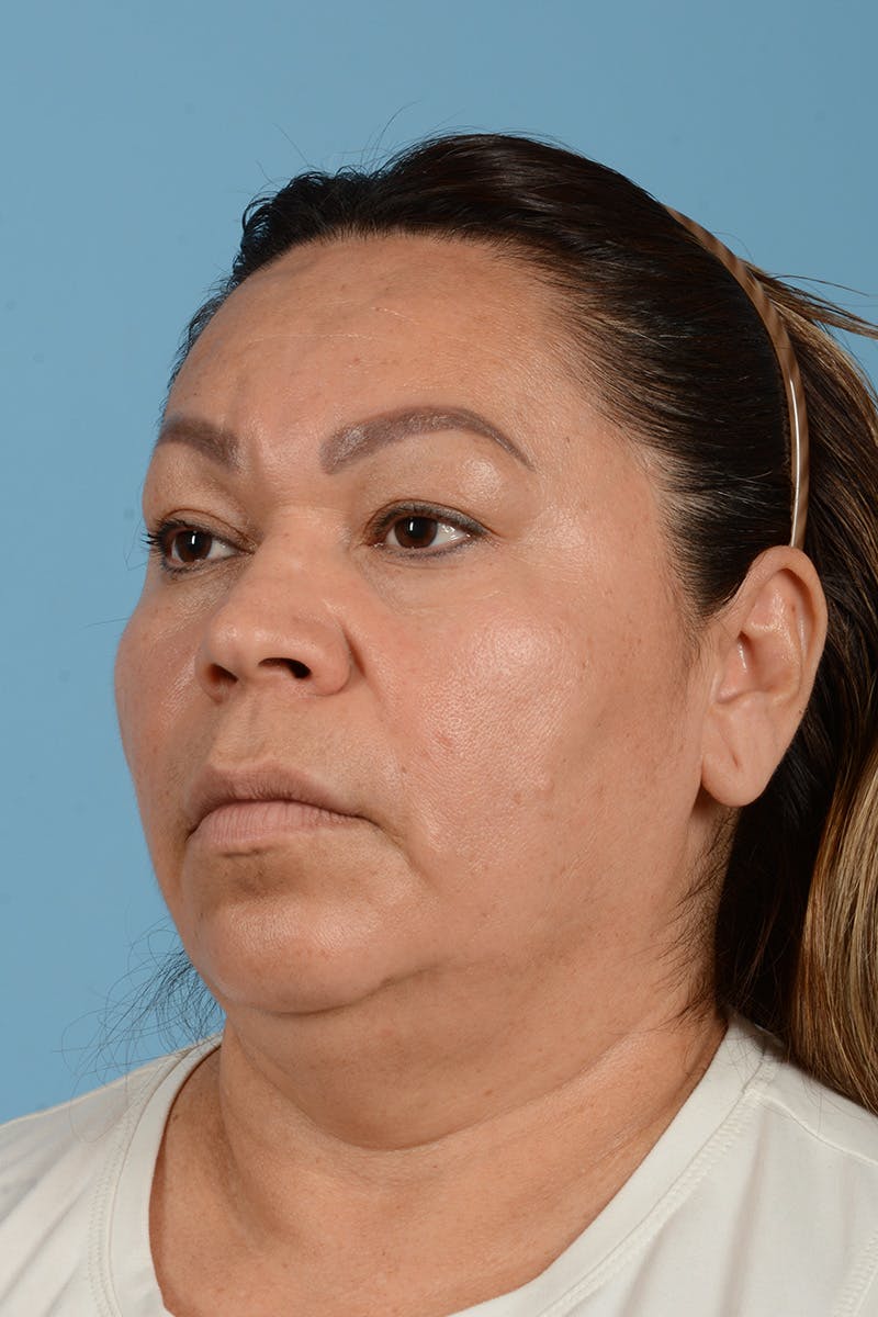 Endoscopic Brow Lift Before & After Gallery - Patient 314786 - Image 9