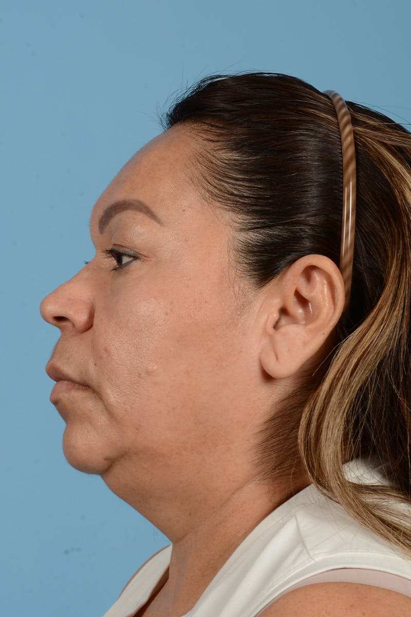 Endoscopic Brow Lift Before & After Gallery - Patient 314786 - Image 11