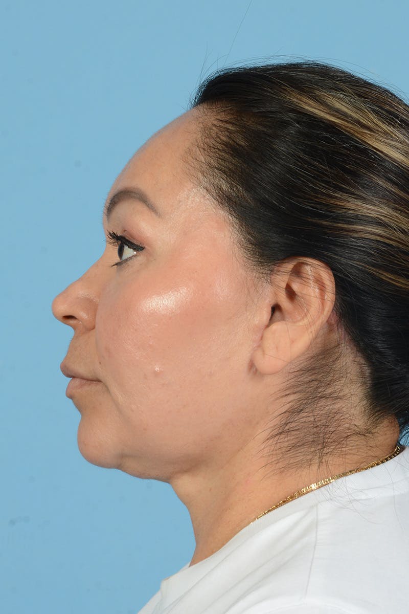 Endoscopic Brow Lift Before & After Gallery - Patient 314786 - Image 12