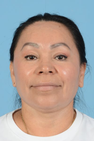 Endoscopic Brow Lift Before & After Gallery - Patient 314786 - Image 4