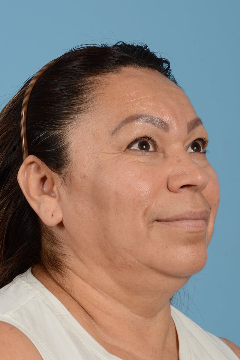 Endoscopic Brow Lift Before & After Gallery - Patient 314786 - Image 5