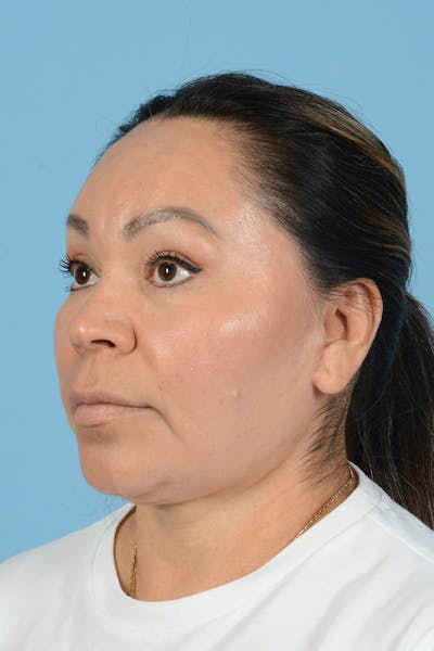 Endoscopic Brow Lift Before & After Gallery - Patient 314786 - Image 10