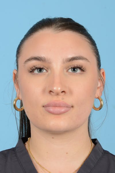 Rhinoplasty Before & After Gallery - Patient 916916 - Image 1